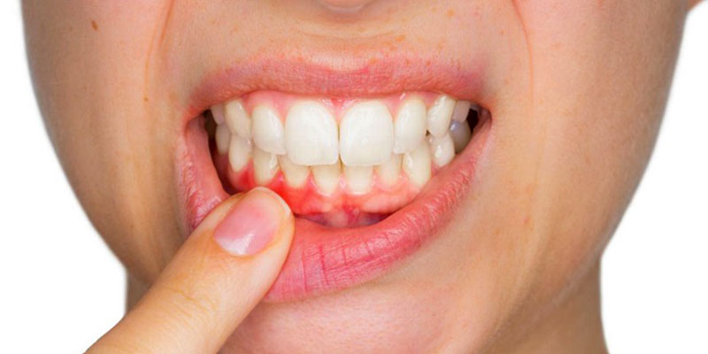 Periodoncia